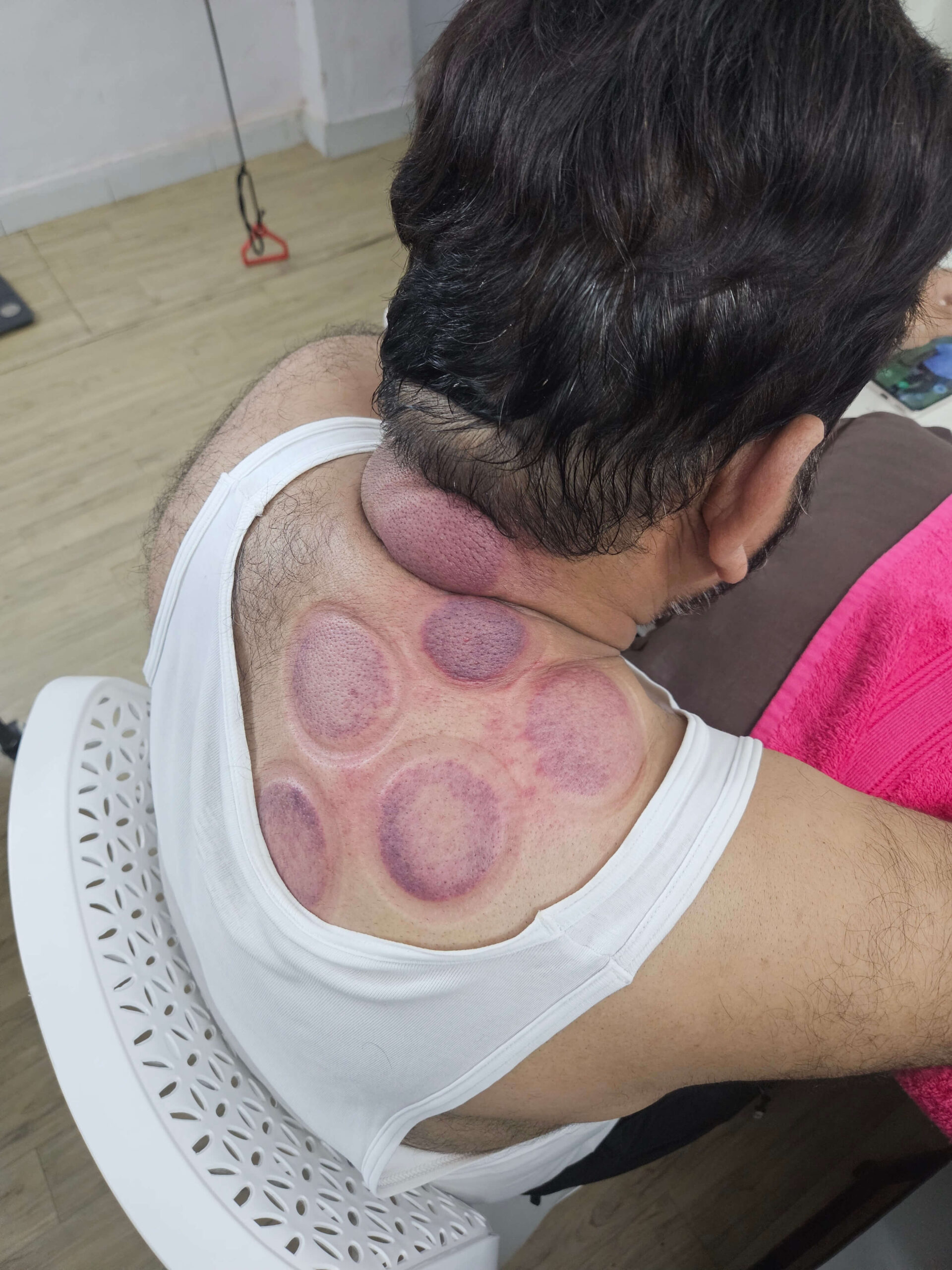 Dry cupping therapy for neck and shoulder stiffness in Rohini, Pitampura Delhi