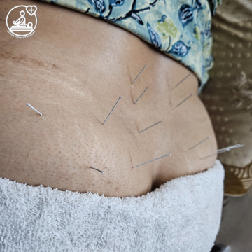Patient receiving Dry Needling therapy for back pain at Jyosa Advance Physiotherapy Rohini Sector 3