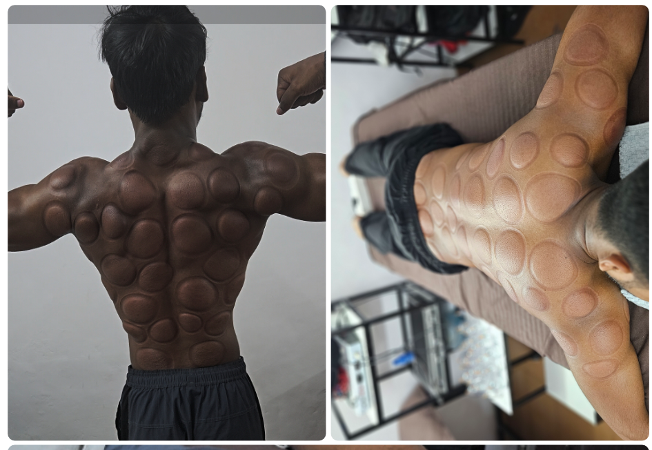 “Collage showing IASTM tool therapy and cupping therapy used for muscle recovery treatment.”
