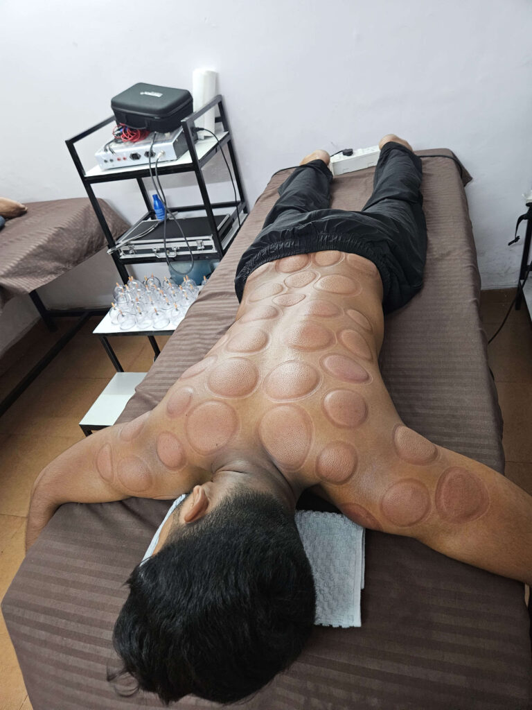 Back muscle recovery session with visible cupping marks on a patient during physiotherapy