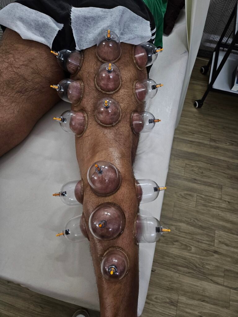 Dry cupping therapy on leg muscles for leg day muscle recovery and IT band pain at Jyosa Advanced Physiotherapy Centre in Rohini Sector 3 Delhi.